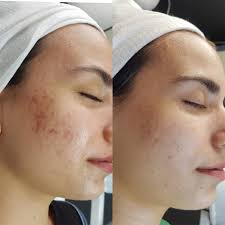 GlowCore™ ديرماستامب الدقيقة